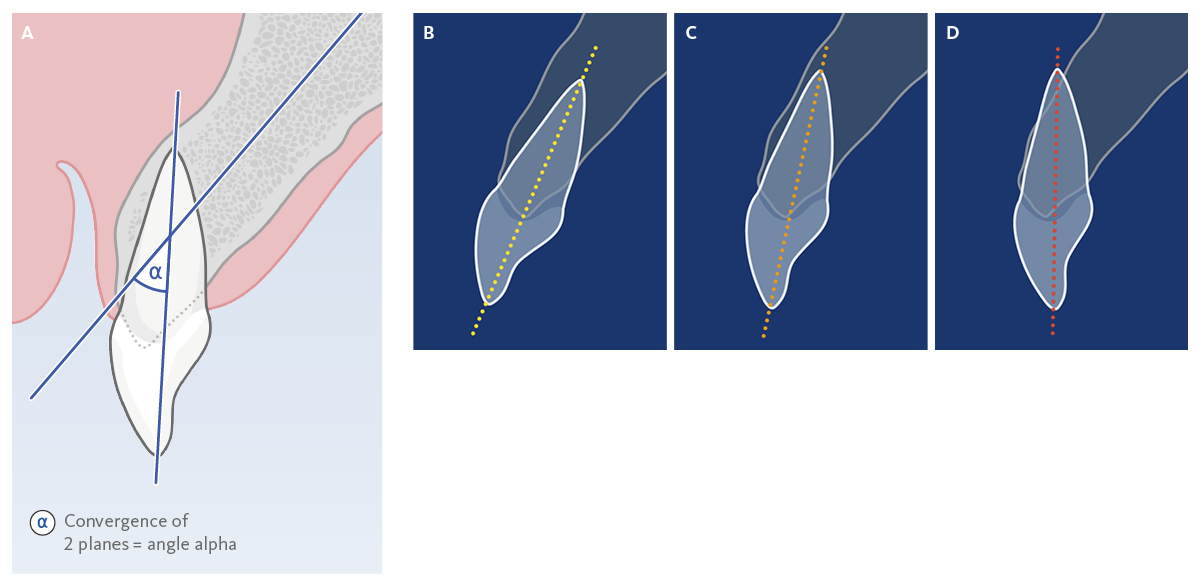 Fig. 1: Angulation
| A Illustration of tooth-root angulation
| B Mild angulation 
| C Moderate angulation
| D Severe angulation